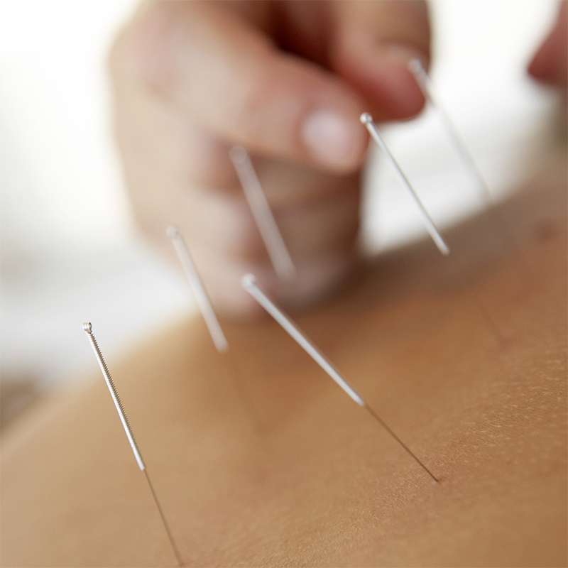 Acupuncture Vancouver